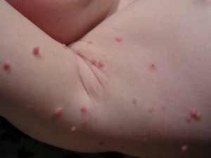 Images of Molluscum Contagiosum