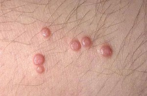 Photos of Molluscum Contagiosum