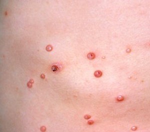 Pictures of Molluscum Contagiosum