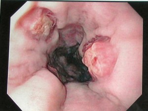 Esophageal Varices Pictures