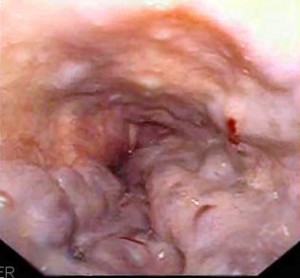 Esophageal Varices Images