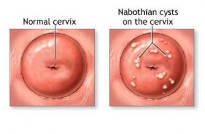 Nabothian Cyst Pictures