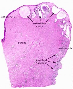 Nabothian Cysts Image