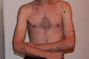 Dermatillomania Photos