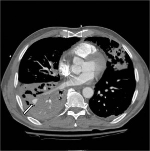 Image of Massive Hemoptysis