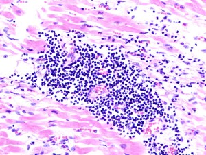 Picture of Myocarditis 