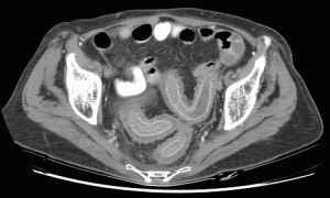 Pancolitis Pictures