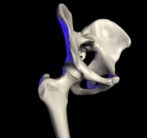 Images of Snapping Hip Syndrome