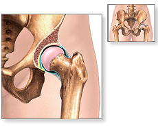 Picture of Snapping Hip Syndrome