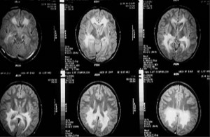 Image of Adrenoleukodystrophy