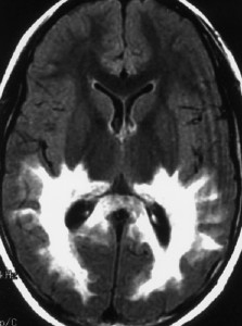 Picture of Adrenoleukodystrophy