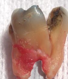 Image of Cracked Tooth Syndrome