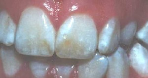 Image of Dental fluorosis