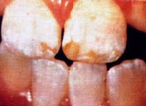 Picture of Dental fluorosis