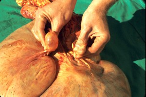 Image of Follicular Cyst