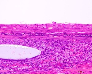 Picture of Follicular Cyst