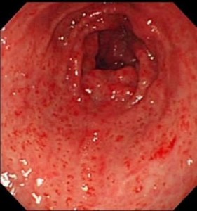 Image of Gastric antral vascular ectasia