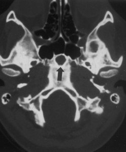 Image of Hyperprolactinemia