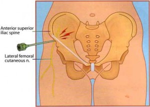 Image of Meralgia Paresthetica