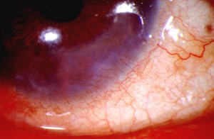 Picture of Ocular rosacea