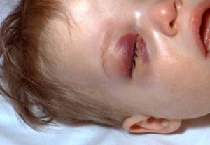 Picture of Periorbital cellulitis