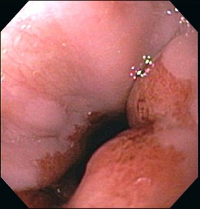 Image of Portal hypertensive gastropathy 