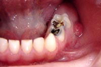 Image of Pulpitis