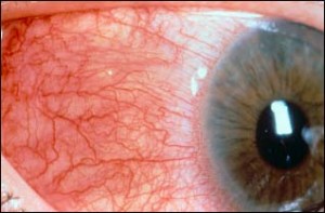 Image of Scleritis