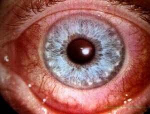 Picture of Scleritis