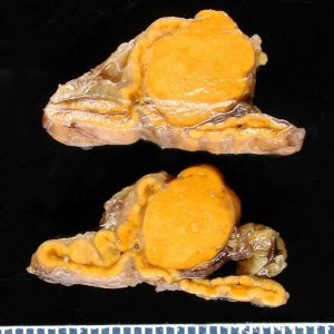 Image of Adrenal Adenoma