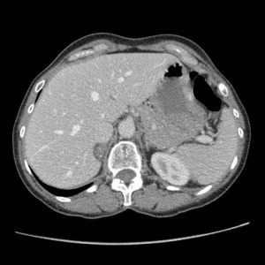 Picture of Adrenal Adenoma