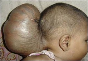 Image of Encephalocele