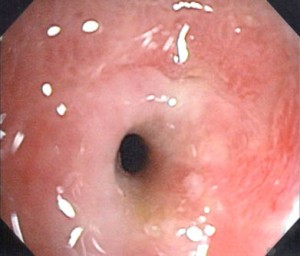 Picture of Gastric outlet obstruction 