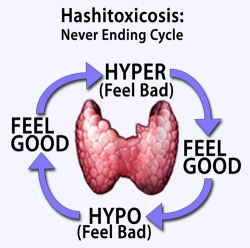 Picture of Hashitoxicosis