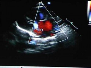 Image of Hypoplastic Left Heart Syndrome