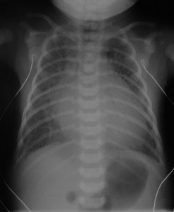 Picture of Hypoplastic Left Heart Syndrome