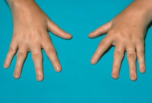 Picture of Juvenile Rheumatoid Arthritis