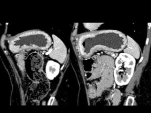 Image of Mesenteric Ischemia