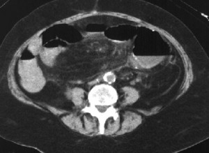 Picture of Mesenteric Ischemia