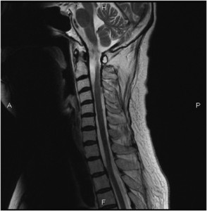 Image of Neurosarcoidosis