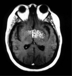 Picture of Neurosarcoidosis