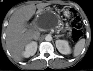 Picture of Pancreatic Pseudocyst