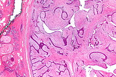 Picture of Phyllodes tumor 