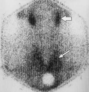 Image of Postpartum thyroiditis