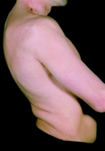Image of Stiff-Person Syndrome