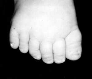 Image of Bardet-Biedl Syndrome 