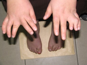 Picture of Bardet-Biedl Syndrome