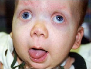 Image of Beckwith-Wiedemann Syndrome