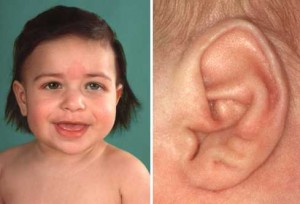 Picture of Beckwith-Wiedemann Syndrome 