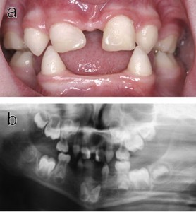 Picture of Ectodermal dysplasia